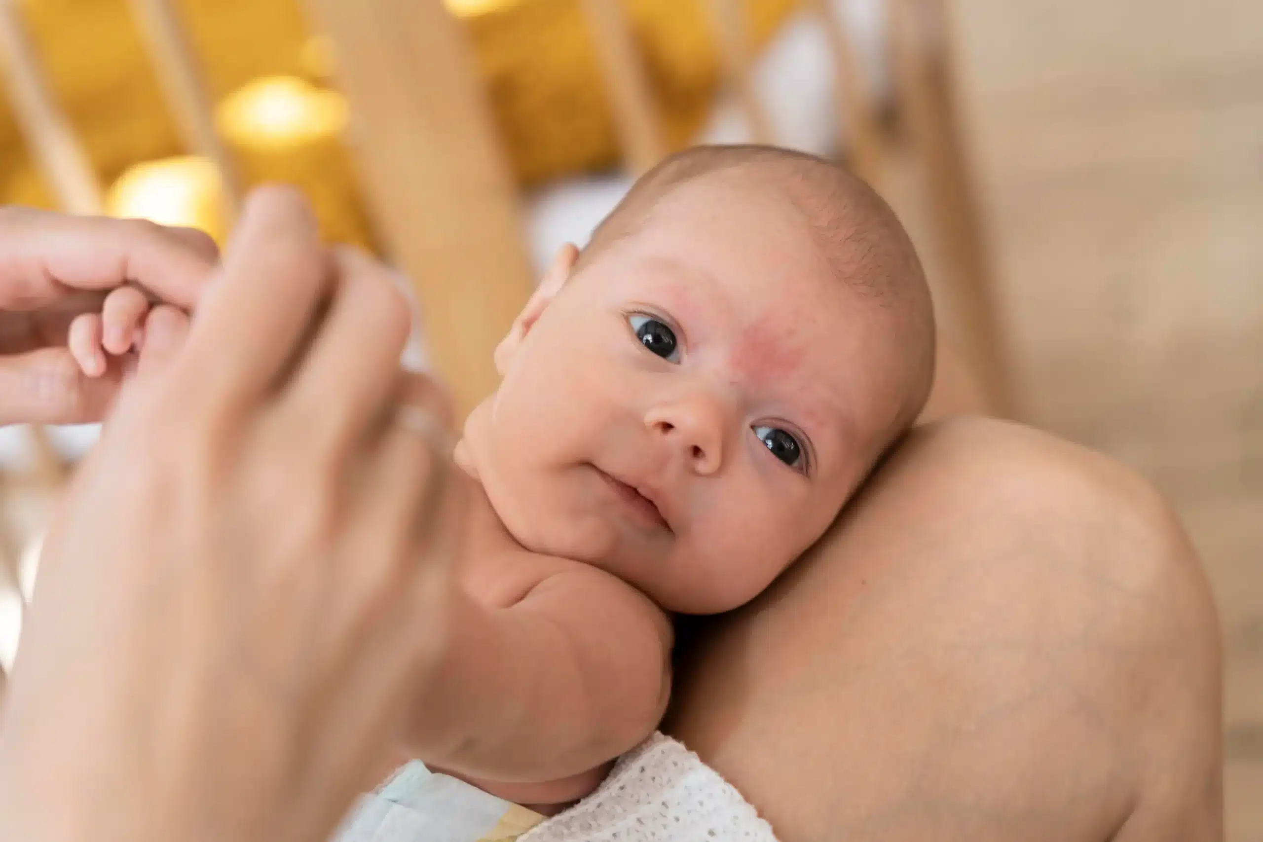 baby acne on face